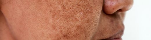 Manchas en la piel: Por qué salen y cómo mantenerlas a raya