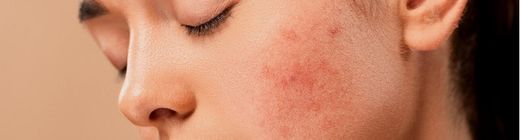 Tips para pieles con acné o granitos