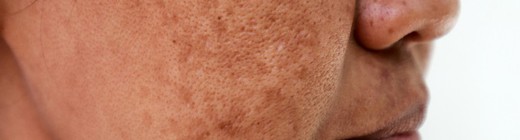 Manchas en la piel: Por qué salen y cómo mantenerlas a raya