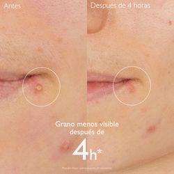 Caudalie Vinopure Stop Boutons Salicylique 15ml